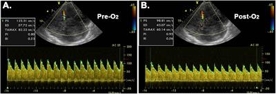 Cerebral Blood Flow, Oxygen Delivery, and Pulsatility Responses to Oxygen Inhalation at High Altitude: Highlanders vs. Lowlanders